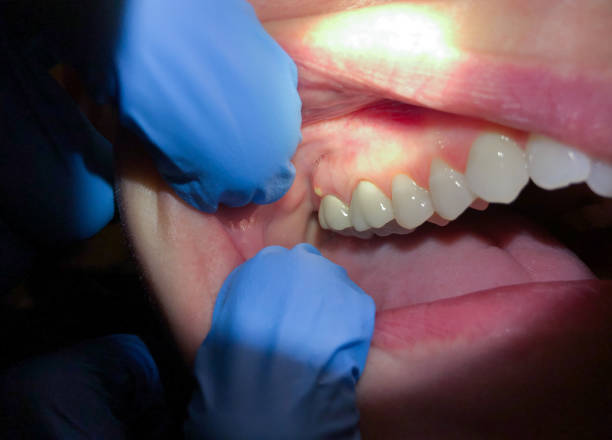 Best Emergency Treatment for Dental Infections or Abscesses in Rice Lake, WI